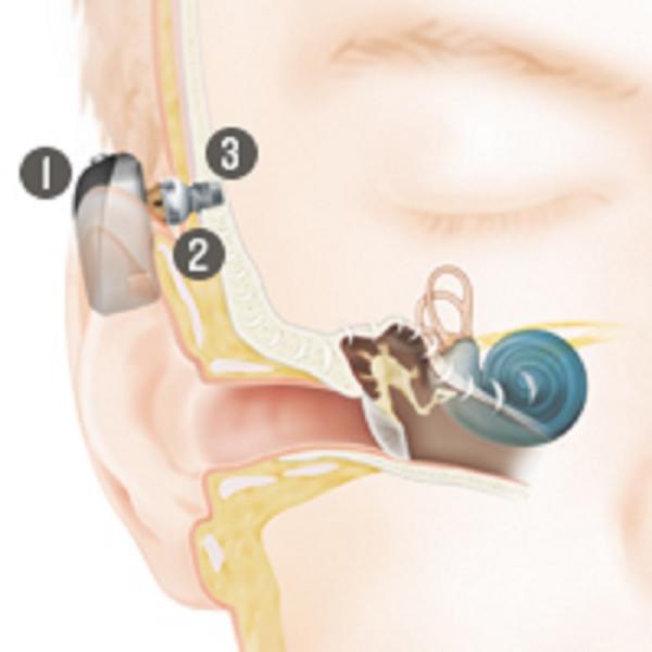 Bone Anchored Hearing Systems Temple Health 3161